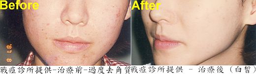 治療前治療後,點看放大圖